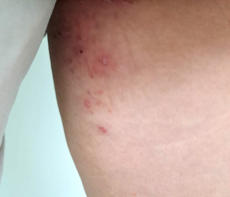 禽蟎喜歡在春夏季節繁衍，嘉義基督教醫院皮膚科主任邱健群建議大家不要在有鳥類活動的地方曬衣服或棉被。 圖：嘉義基督教醫院／提供