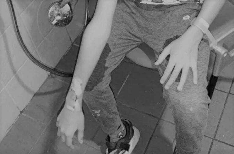 新北男童配戴智慧手錶「Hero Watch」突然發生爆炸，讓他右手臂嚴重燙傷恐需植皮。昨日晚間該款手錶的業者「About Time 關於時間」於臉書上發出道歉聲明。 圖：民眾提供