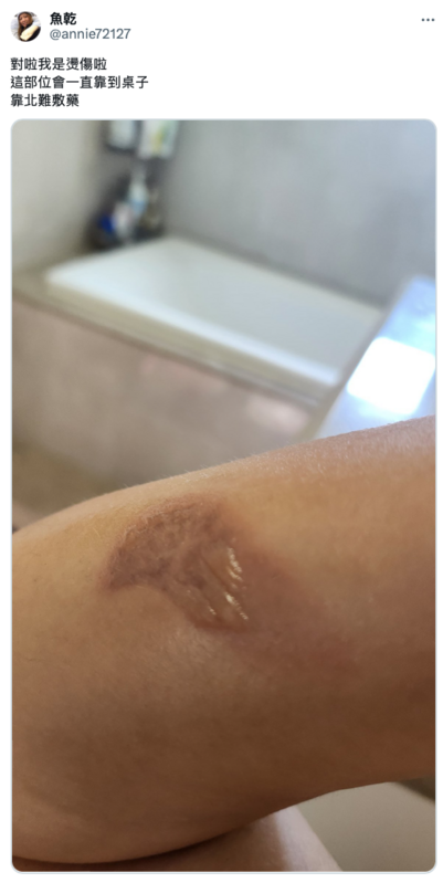 對此，她在推特證實是燙傷，更曬出傷勢照，讓大批粉絲相當心疼。 圖：翻攝自Twitter＠annie72127