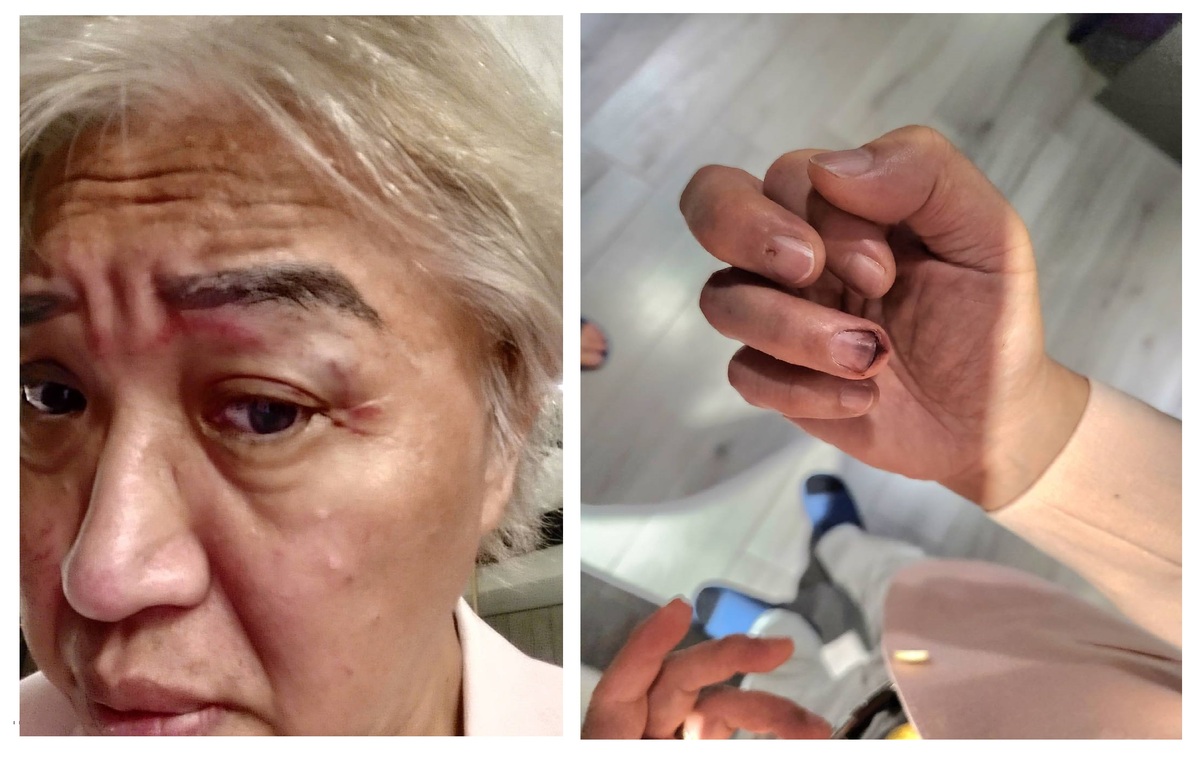 鄭為元出示照片說明雙方發生衝突當天，他的眼角和手指都被躶女弄傷。 圖：孫家銘翻攝
