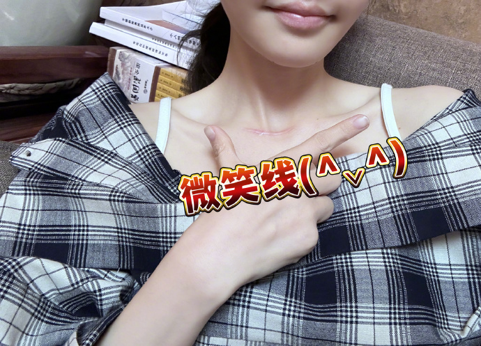 馮提莫公開自己手術疤痕，是「微笑線」的模樣。 圖：翻攝自馮提莫微博