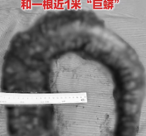 醫生在女子腹內取出約一公尺長的「巨蟒」。 圖：翻攝自新浪新聞微博