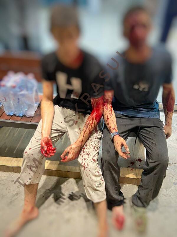 兩名青少年遭爆炸波及受傷，身上多處沾染血跡，所幸並無大礙。 圖：翻攝自Ask Rasul Telegram