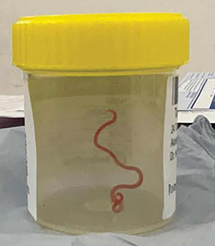 澳洲一名女性大腦中取出一條活的寄生蟲，長度約為 8 公分長，取出時還在蠕動。 翻攝自 X ( 前推特 )