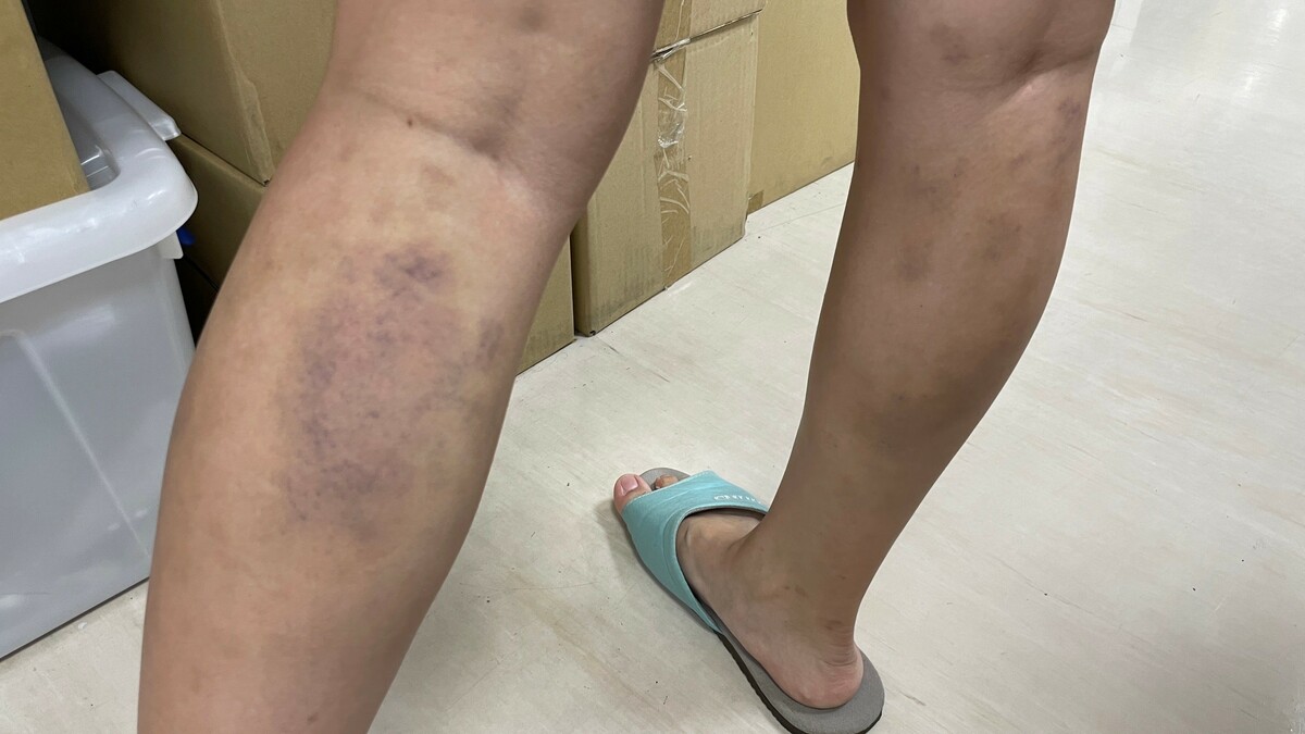 吳姓婦人接受「撥筋」民俗療法，沒想到隔天起床發現小腿肚「宛如家暴毆傷」。 亞大醫院/提供