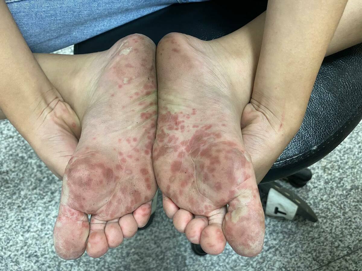 小兒科醫師陳木榮今在臉書上PO出手腳長滿紅點的照片表示，當兒科醫生那麼多年，每隔一陣子遇到一些出疹嚴重的腸病毒孩子，還是會覺得怵目驚心。 圖：翻攝自柚子醫師的育兒診療室 - Dr.陳木榮醫師 臉書專頁