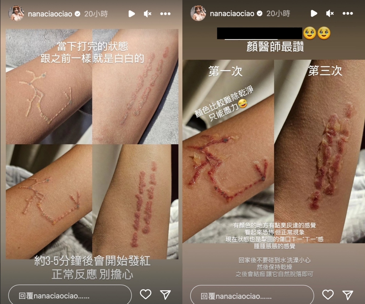 阿圓更曬出術後的照片，直呼「有點臭灰達的感覺」。 圖：翻攝自IG@nanaciaociao