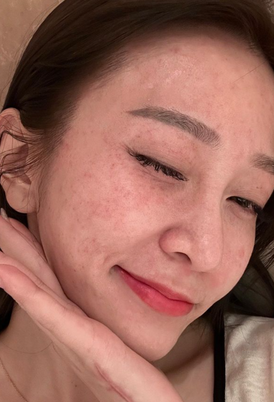 篠崎泫挑戰玩高空彈跳後，因為壓力的關係臉上跟脖子上的微血管全部爆裂，浮現出一塊塊紅斑，模樣相當怵目擊心。 圖：翻攝自篠崎泫IG
