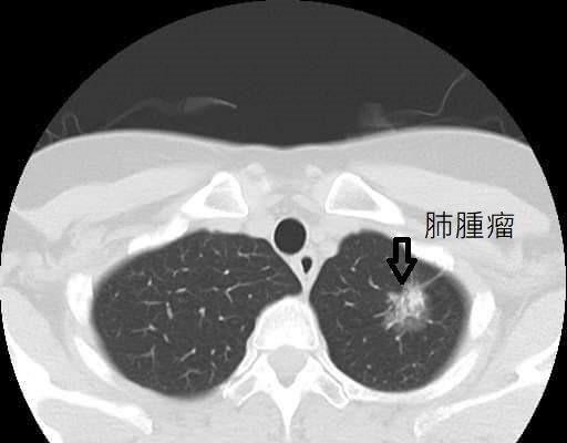 肺腫瘤及肺癌示意圖。 圖：取自衛生福利部桃園醫院
