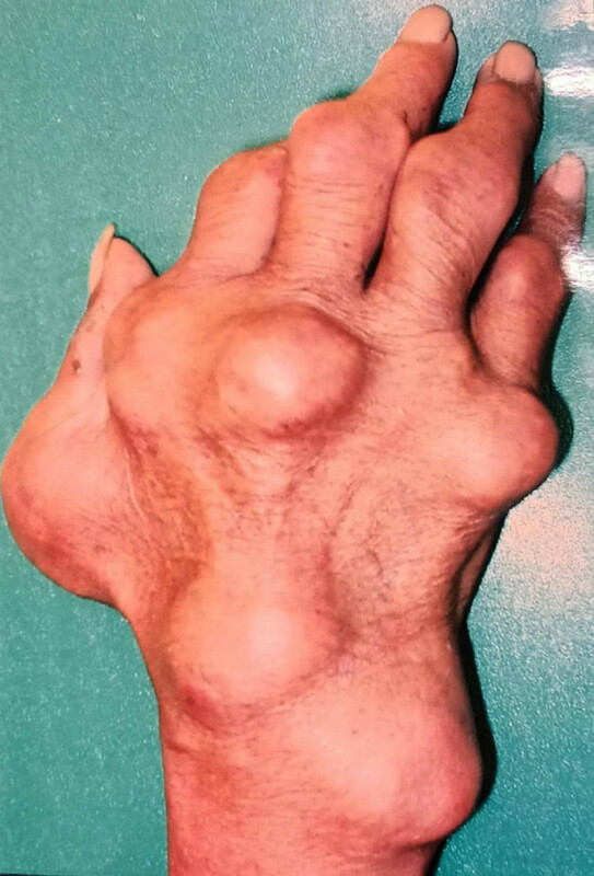 賴漢明醫師表示，一名40歲男性因關節炎和無痛結節，後出現嚴重腫痛和發燒，確診為慢性痛風性關節炎。隨後又併發腎結石和腎盂腎炎，並引發敗血症。 圖：賴漢明／提供