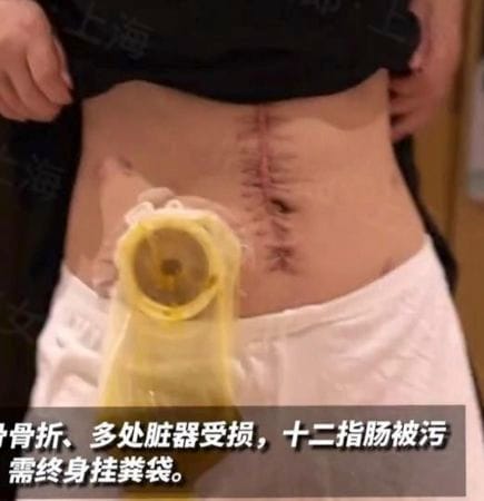 小謝被賀姓丈夫打到腎、肝、肺等內臟均受損傷，十二指腸也被污染，無法排便，必須終身掛著糞袋。 圖：翻攝微博