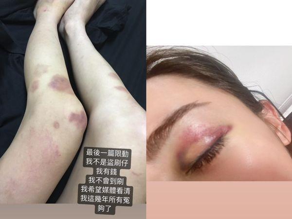 罔腰被打到全身8處受傷。 圖：翻攝自罔腰IG