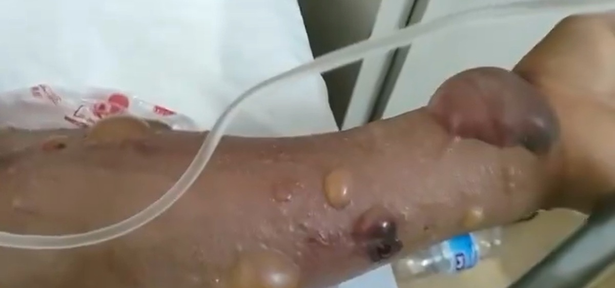 中國近期爆發炭疽病。 圖：翻攝自德潤傳媒 X 帳號