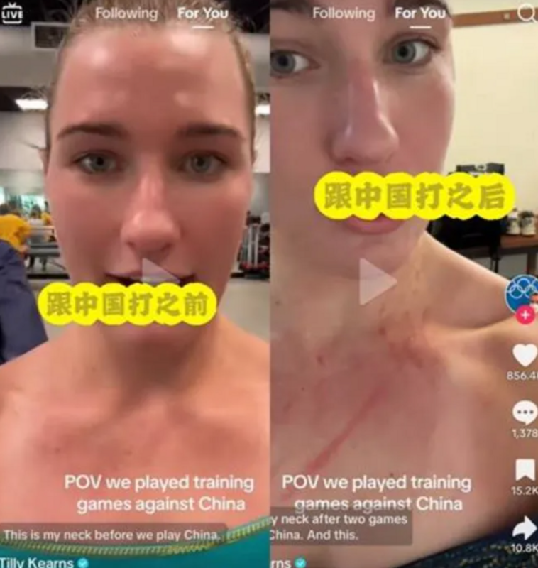 澳球女子水球隊主將基恩絲，近期在 TikTok 分享與中國隊打完友誼賽後受傷的圖片。 圖：翻攝自抖音