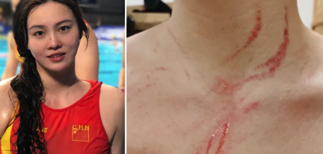 中國女子水球隊隊長熊敦瀚表示，自己胸口與脖子也有受傷。 圖：翻攝自微博