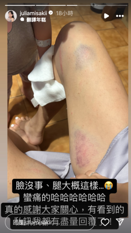 咪妃曬出傷勢照，可以看到大腿的上方及內側都有大片紫紅色瘀青，小腿也包上了紗布。 圖：翻攝自咪妃IG
