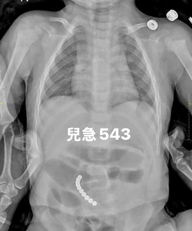 兒急診主治醫師吳昌騰在臉書警告，巴克球(小磁球)對幼兒危害極大，稱之為「二魔王」，僅次於鈕扣電池。 圖：翻攝自來講兒科急診的543-吳昌騰醫師