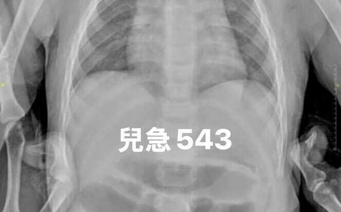 巴克球超危險！1歲童竟吞10顆釀腸穿孔 醫警告：初期無症狀難察覺
