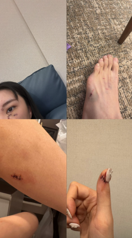 可以看到Wendy的臉頰、手指、小腿、腳背都有傷口，畫面相當怵目驚心。 圖：翻攝自Wendy Threads
