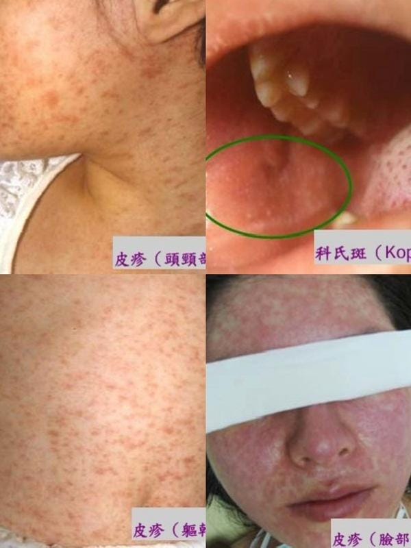 清明連假期間曾有外縣市麻疹確診個案至安平老街及鹿耳門天后宮等2個知名景點。(圖為麻疹狀況示意)  圖：高雄長庚醫院黃高彬部長、疾管署／提供 新頭殼合成