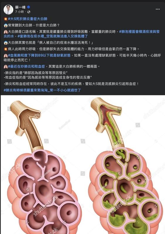 醫師蘇一峰解釋，大S死於肺炎重症大白肺 ，此為嚴重肺炎，患者最終恐因缺氧猶如「被自己痰液水腫淹死」。 圖：翻攝自蘇一峰 臉書專頁