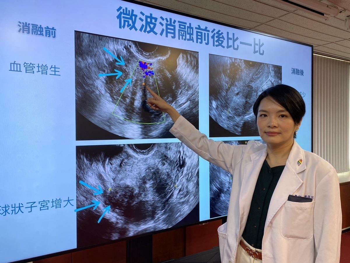 臺中榮總婦女醫學部醫師謝筱芸說明，透過超音波可見子宮肌腺症患者的子宮有血管增生。 圖：台中榮總/提供