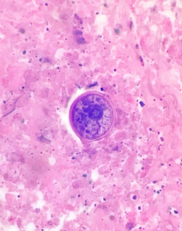 隨著全球範圍內一種名為球孢子菌（Coccidioides）的致命真菌迅速蔓延，世界衛生組織已將其列為迫切需要研究的新型病原之一。 圖:翻攝自X帳號@janiranavarro