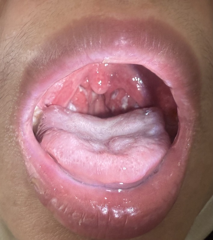 賴韋圳醫師指出，急性喉炎通常會出現喉嚨痛，咽喉紅腫，發燒，乾咳、黃痰、吞嚥不適，耳朵痛，頭痛，扁條腺腫大或化膿，頸部淋巴腺腫大等10大症狀。 圖：翻攝自兒科三百首賴韋圳中醫師臉書
