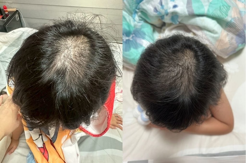 根據香港研究顯示，COVID-19疫情期間出生寶寶缺少維持腸道微生態健康天然抗菌肽基因，患上濕疹等過敏症發病率較疫情前出生的嬰兒多46%。圖為幼童使用益生菌外用產品，頭皮與髮絲狀態改善，原本容易抓癢或不適情況逐漸穩定下來。（營養師羅晞蕾提供）中央社記者陳婕翎傳真  114年6月15日 圖: 營養師羅晞蕾/提供(中央社)