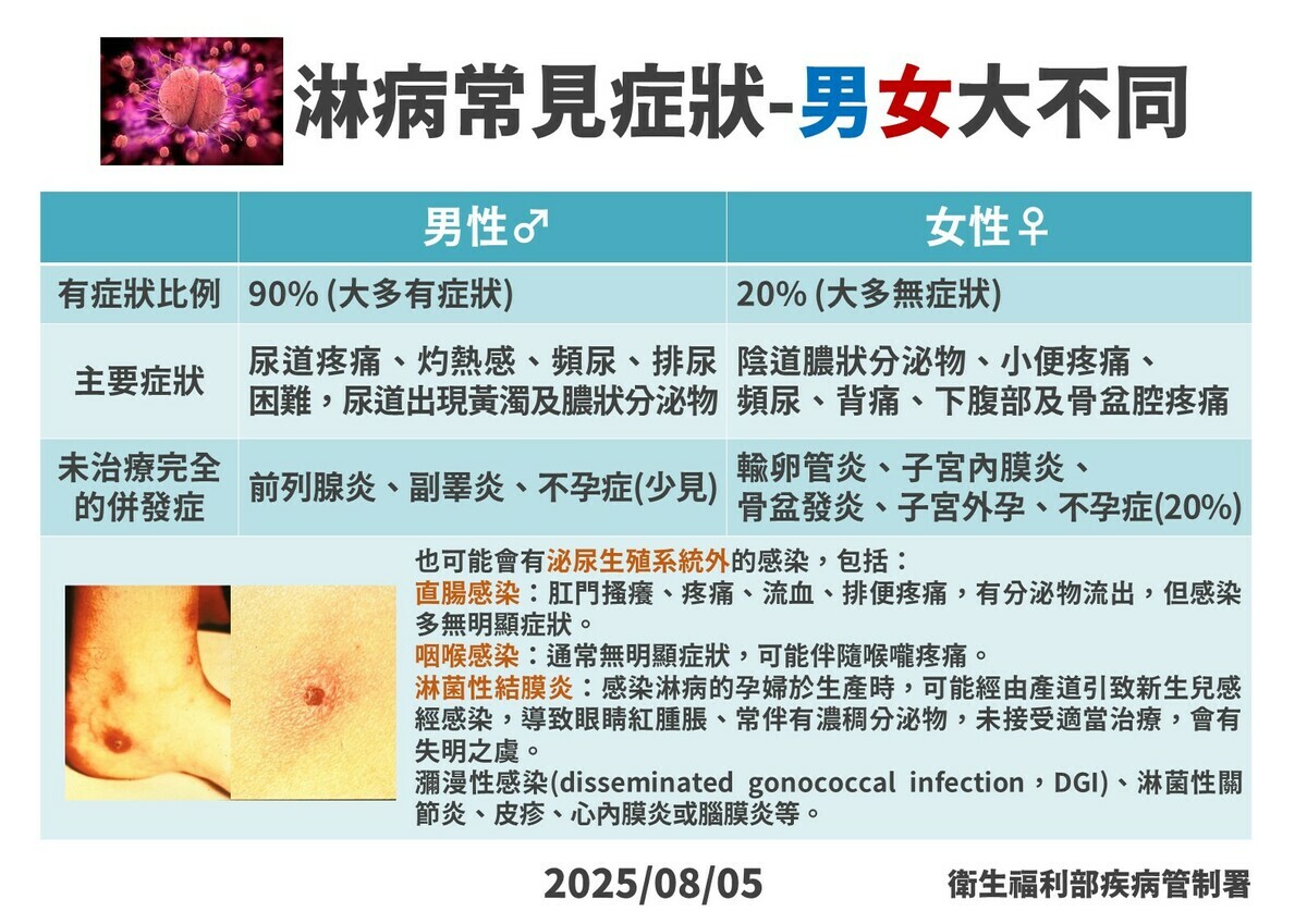 淋病症狀男女有別，男性九成有尿道灼熱、流膿等症狀，女性則有八成無症狀，輕忽恐致不孕。 圖：疾管署／提供