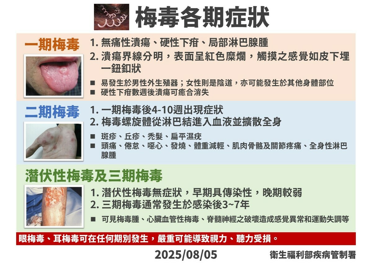 梅毒分為三期，初期為無痛硬下疳；二期梅毒螺旋體擴散，引發皮疹、頭痛；三期則可能出現梅毒瘤、心血管或神經病變。此外，任何期別都可能併發眼、耳梅毒，嚴重時恐導致視力或聽力受損。 圖：疾管署／提供