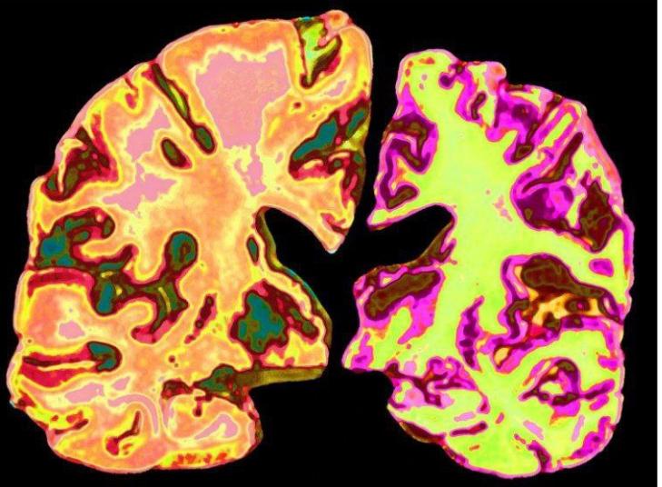 哈佛醫學院研究團隊在《Nature》期刊發表最新研究，指出大腦鋰含量可能與阿茲海默症的發展息息相關。 圖：翻攝自 X