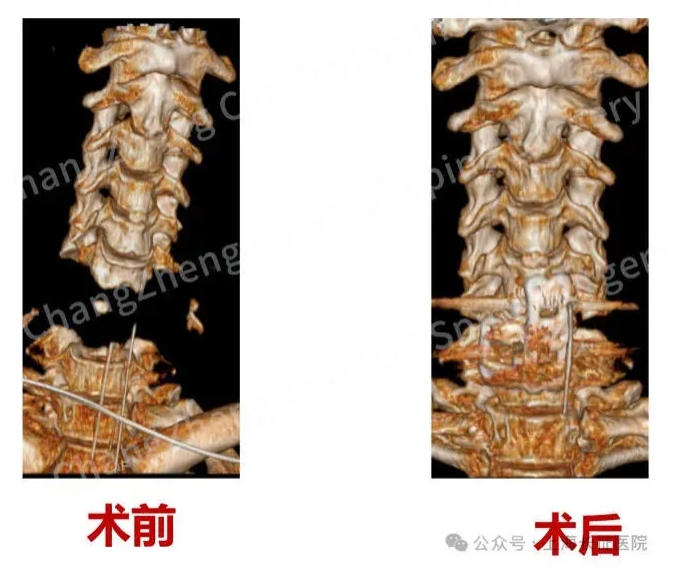 患者在手術前，頸椎已成分離狀態(左)，手術後重新結合。 圖 : 翻攝自上海長征醫院微信公眾號