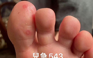 武漢肺炎》再現特殊症狀！無症狀感染兒童腳趾佈滿鮮紅色腫塊
