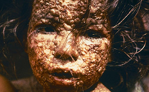 美藥企實驗室驚見 15瓶天花病毒 CDC緊急接收保管