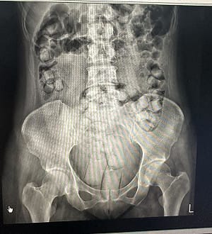 2泰女體內藏115顆海洛英來台　入境遭攔截送辦