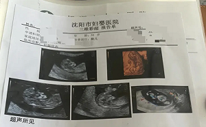 產檢一次多一胎! 罕見同卵四胞胎 遼寧女懷孕16週 第四胎為無心畸胎