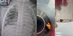 1歲娃肺塌陷險死！元兇竟是「阿嬤的花生」 醫曝2小時搏命救援內幕