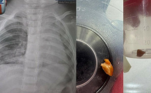 1歲娃肺塌陷險死！元兇竟是「阿嬤的花生」 醫曝2小時搏命救援內幕