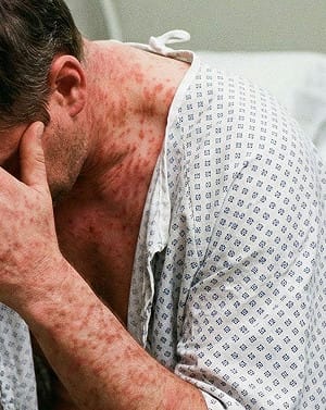 以為只是小感冒？高燒不退加「這些症狀」別輕忽！重症醫揭成人麻疹5大警訊