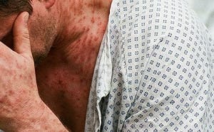 以為只是小感冒？高燒不退加「這些症狀」別輕忽！重症醫揭成人麻疹5大警訊