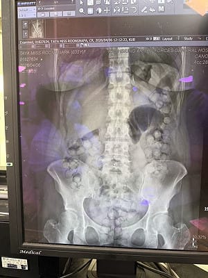 泰籍女子吞72顆海洛因膠囊　藏毒跨海來台遭逮