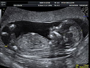 胎兒超音波 未要求掃描四肢 監院促改善