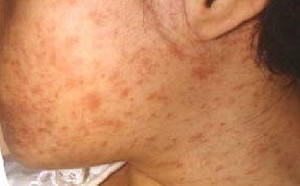 國內新增2起麻疹病例  疾管署呼籲：疑似個案盡速通報