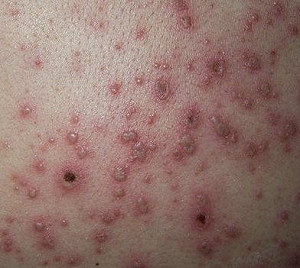 水痘群聚感染未通報、防疫 高雄某大學挨罰