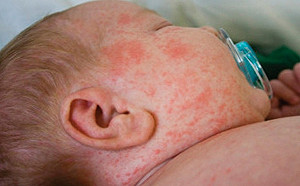 麻疹再添本土案例  衛福部：恐有隱性社區個案