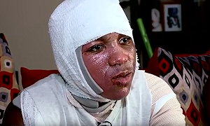 美恐怖熱水挑戰引模仿 少年全身二級燙傷 (影)