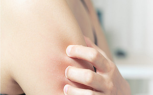 秋冬乾癬復發高峰期  癬友生活飲食應有所節制