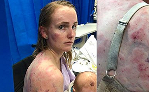 母愛本能 澳洲媽媽肉體護女 遭冰雹打傷