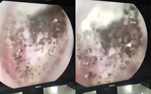 （影）耳朵又癢又痛 檢查發現內成「蘑菇森林」